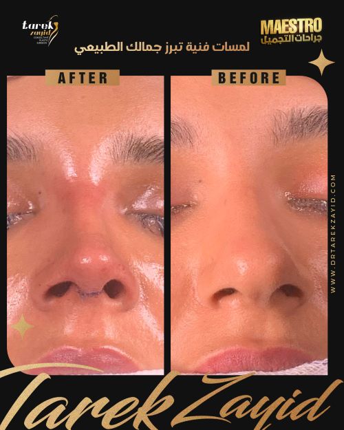 مدة الشفاء من عملية تجميل الأنف